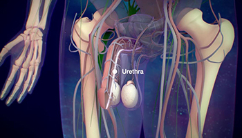 Urethral Stricture Treatment