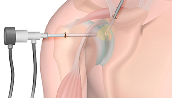 Shoulder Arthroscopy