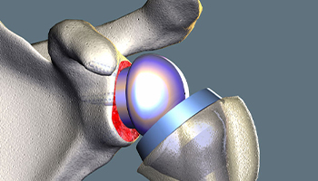 Shoulder Replacement