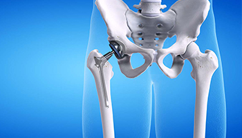 Hip Replacement