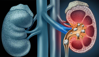 Kidney Stone Treatment